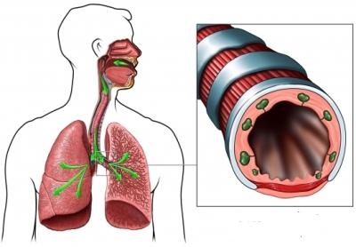 poza despre microlitiaza alveolara